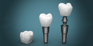 dental implant structure